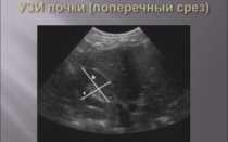 Лекции по узи почек