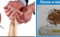 Какие ощущения при выходе песка из почек