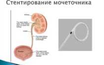Кровь в моче после стентирования мочеточника