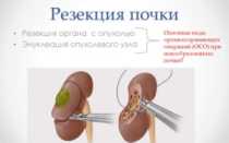 Жизнь после удаления опухоли почки