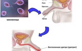 Боль в головке члена при мочеиспускании